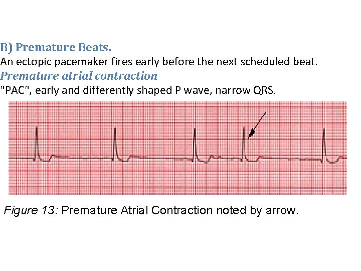 B) Premature Beats. An ectopic pacemaker fires early before the next scheduled beat. Premature