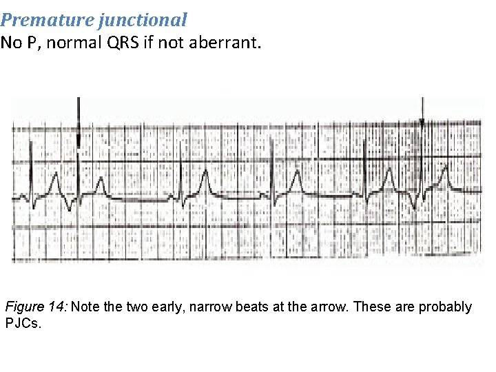 Premature junctional No P, normal QRS if not aberrant. Figure 14: Note the two