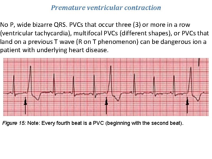 Premature ventricular contraction No P, wide bizarre QRS. PVCs that occur three (3) or