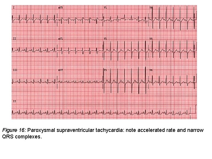Figure 16: Paroxysmal supraventricular tachycardia: note accelerated rate and narrow QRS complexes. 