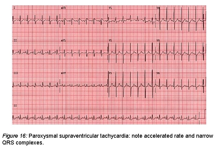 Figure 16: Paroxysmal supraventricular tachycardia: note accelerated rate and narrow QRS complexes. 
