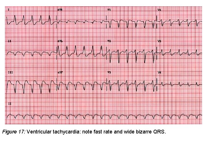 Figure 17: Ventricular tachycardia: note fast rate and wide bizarre QRS. 