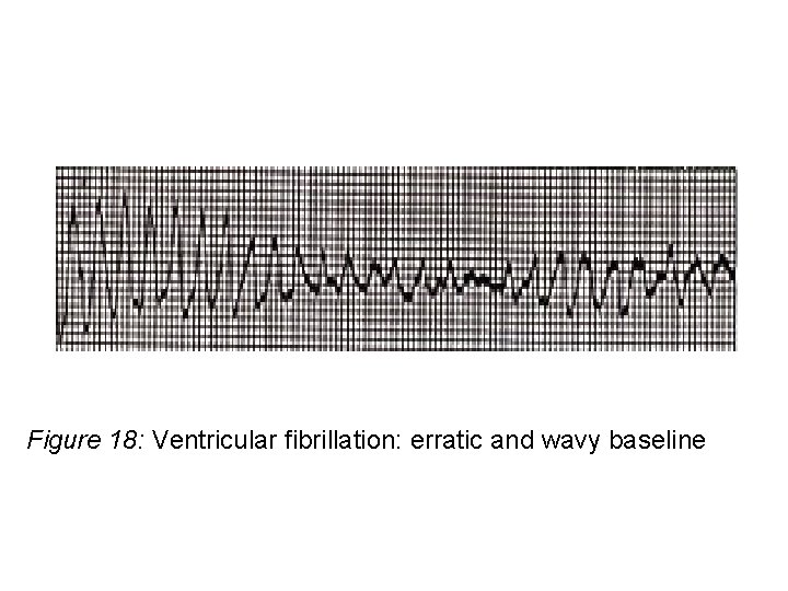 Figure 18: Ventricular fibrillation: erratic and wavy baseline 