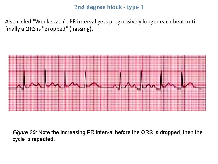 2 nd degree block - type 1 Also called "Wenkebach". PR interval gets progressively