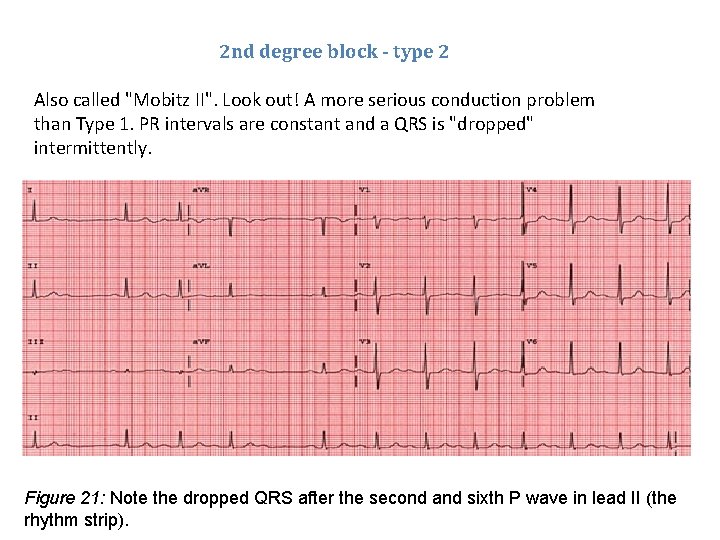 2 nd degree block - type 2 Also called "Mobitz II". Look out! A