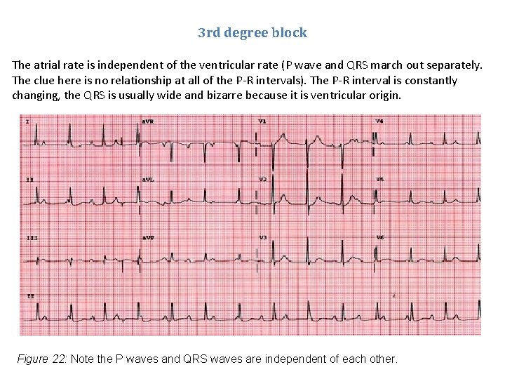 3 rd degree block The atrial rate is independent of the ventricular rate (P