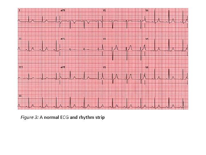 Figure 3: A normal ECG and rhythm strip 