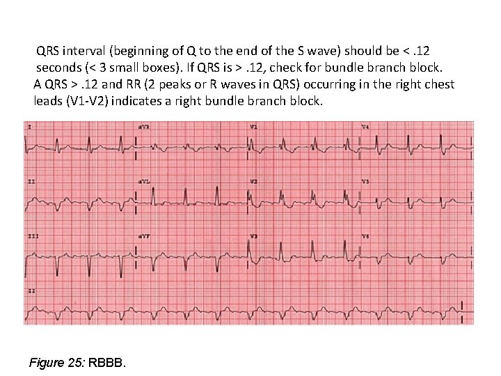 QRS interval (beginning of Q to the end of the S wave) should be