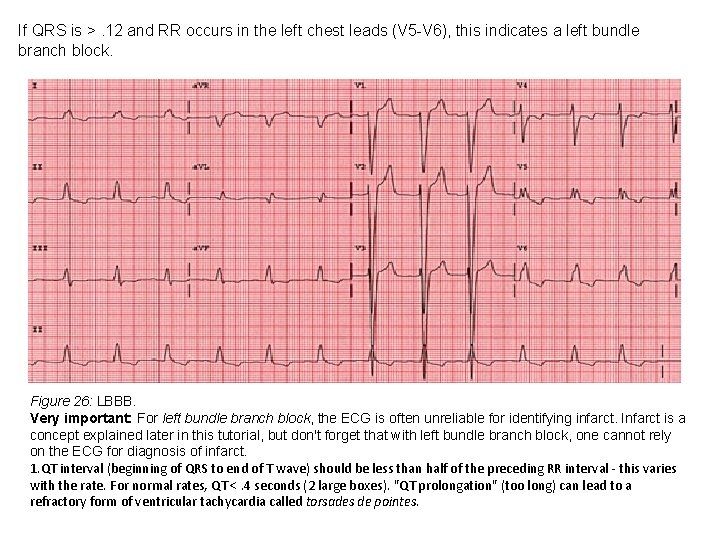 If QRS is >. 12 and RR occurs in the left chest leads (V