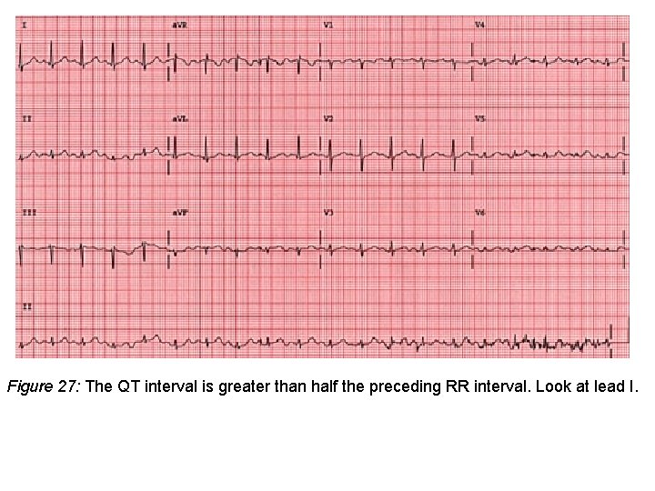 Figure 27: The QT interval is greater than half the preceding RR interval. Look