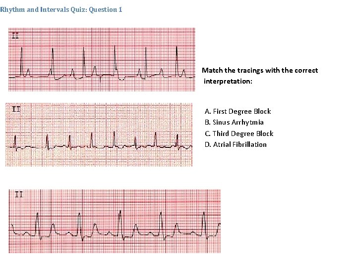 Rhythm and Intervals Quiz: Question 1 Match the tracings with the correct interpretation: A.