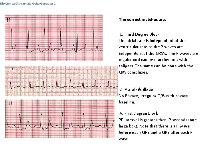 Rhythm and Intervals Quiz: Question 1 The correct matches are: C. Third Degree Block