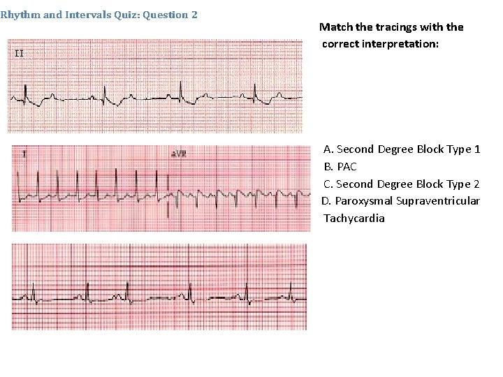 Rhythm and Intervals Quiz: Question 2 Match the tracings with the correct interpretation: A.