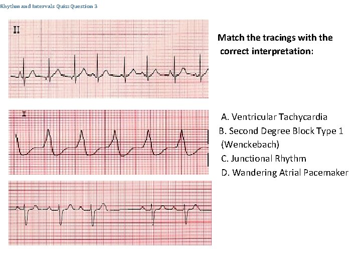 Rhythm and Intervals Quiz: Question 3 Match the tracings with the correct interpretation: A.