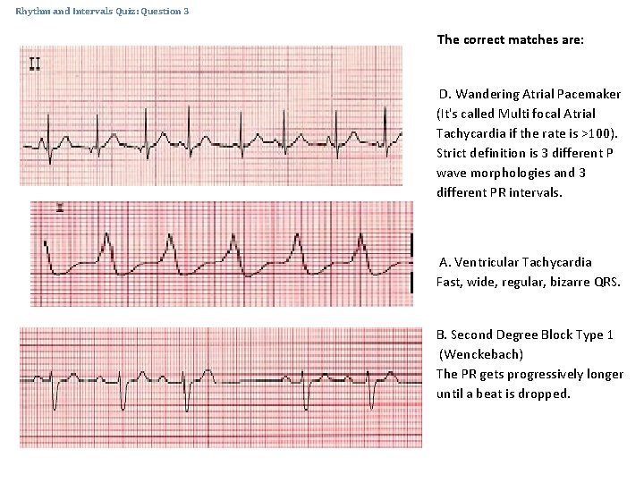 Rhythm and Intervals Quiz: Question 3 The correct matches are: D. Wandering Atrial Pacemaker