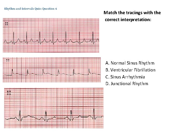 Rhythm and Intervals Quiz: Question 4 Match the tracings with the correct interpretation: A.