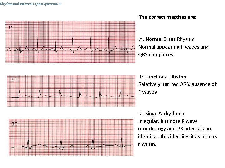 Rhythm and Intervals Quiz: Question 4 The correct matches are: A. Normal Sinus Rhythm
