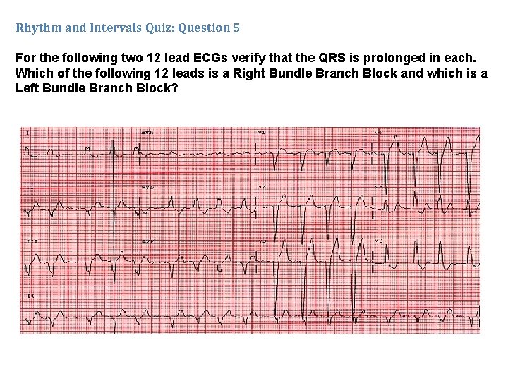 Rhythm and Intervals Quiz: Question 5 For the following two 12 lead ECGs verify