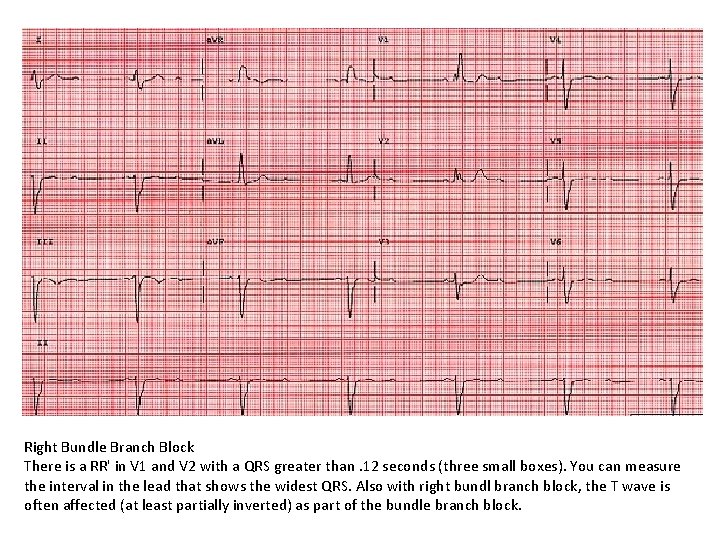 Right Bundle Branch Block There is a RR' in V 1 and V 2