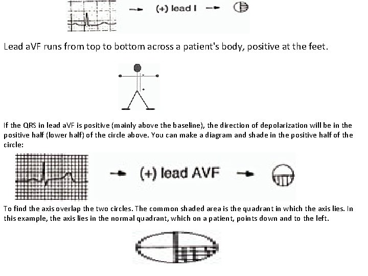 Lead a. VF runs from top to bottom across a patient's body, positive at