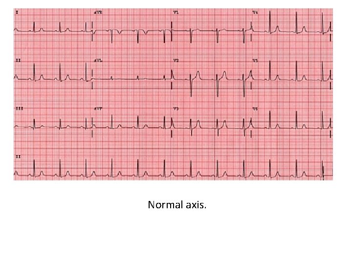 Normal axis. 