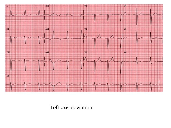 Left axis deviation 