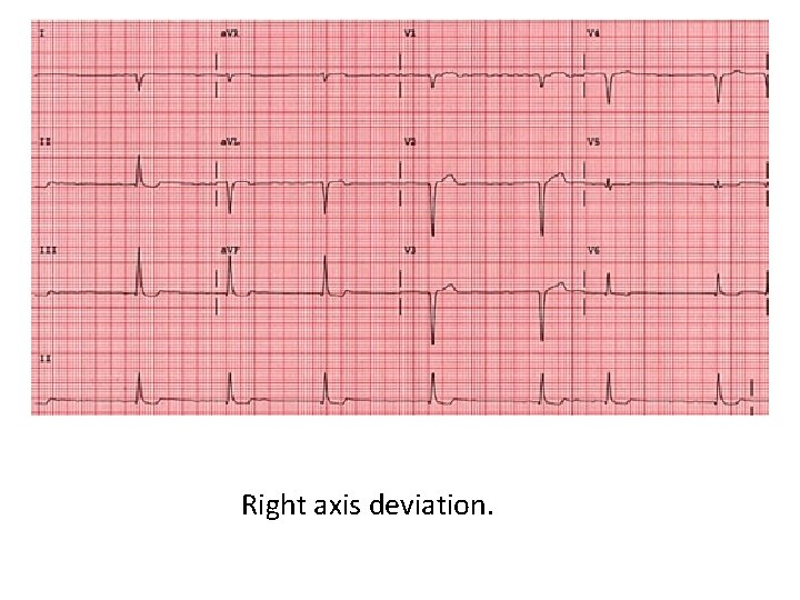 Right axis deviation. 