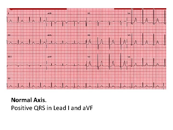 Normal Axis. Positive QRS in Lead I and a. VF 