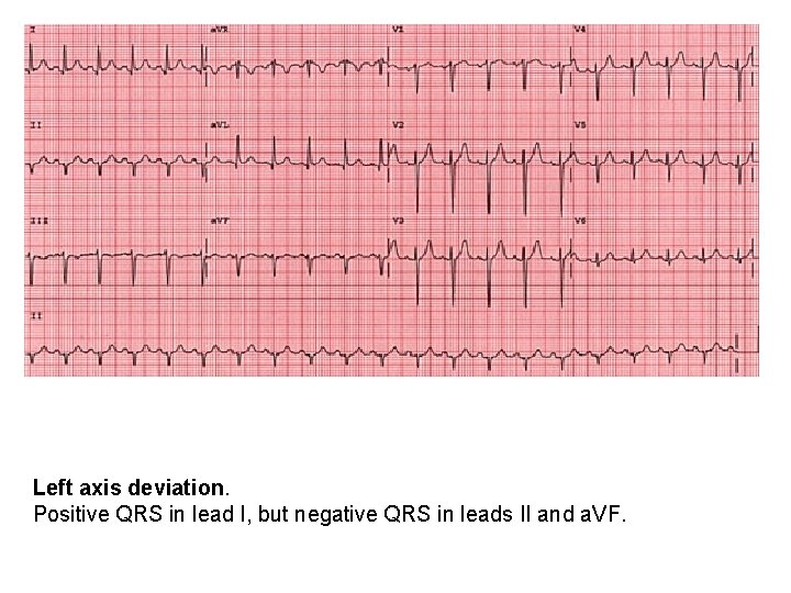 Left axis deviation. Positive QRS in lead I, but negative QRS in leads II