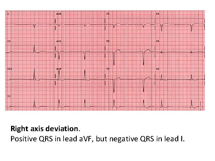 Right axis deviation. Positive QRS in lead a. VF, but negative QRS in lead