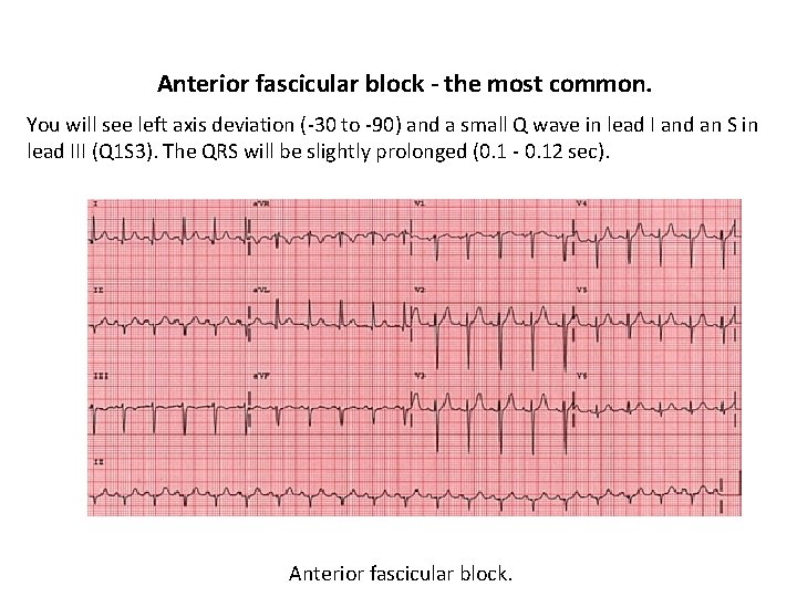 Anterior fascicular block - the most common. You will see left axis deviation (-30
