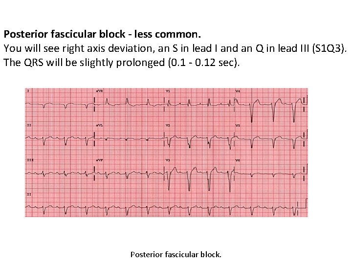 Posterior fascicular block - less common. You will see right axis deviation, an S