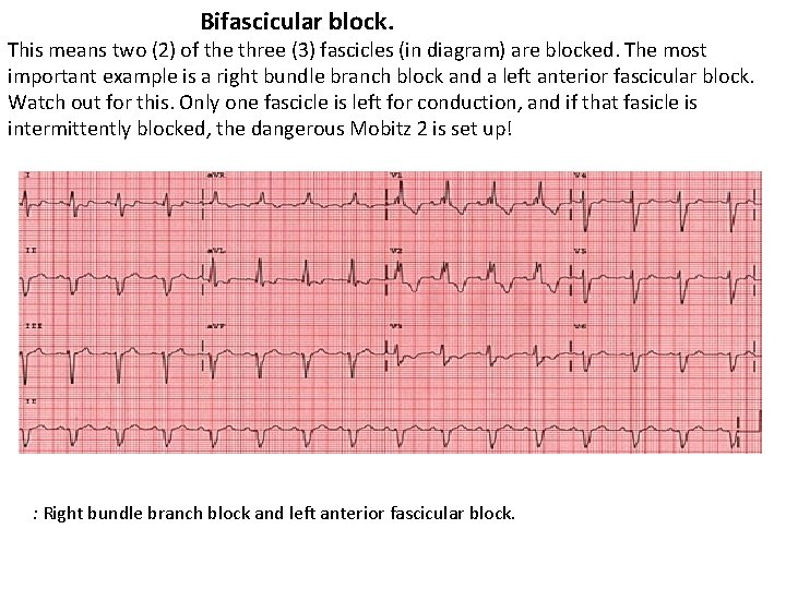 Bifascicular block. This means two (2) of the three (3) fascicles (in diagram) are