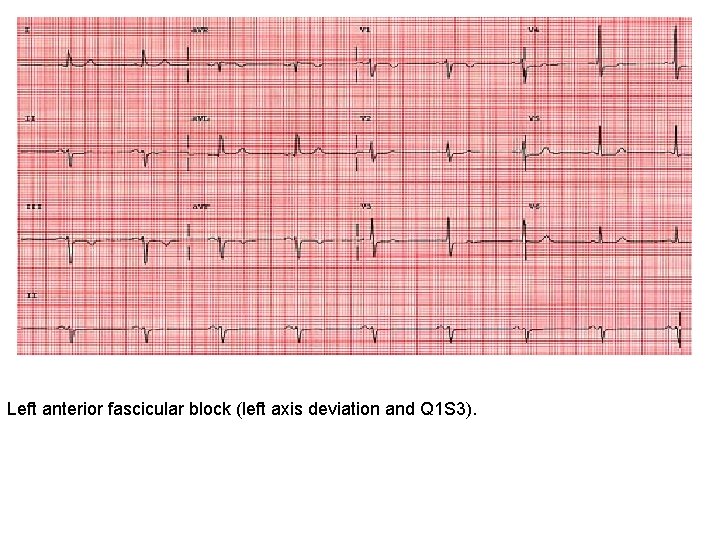 Left anterior fascicular block (left axis deviation and Q 1 S 3). 