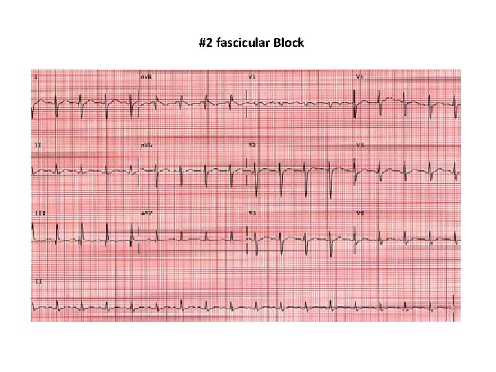 #2 fascicular Block 