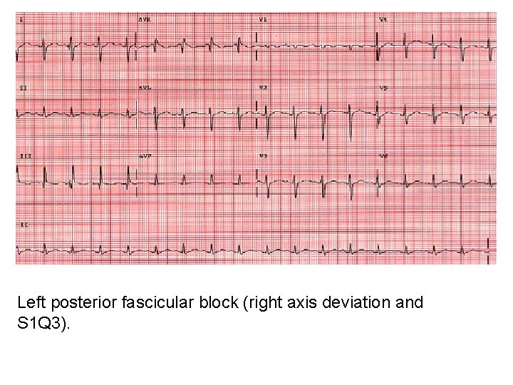 Left posterior fascicular block (right axis deviation and S 1 Q 3). 