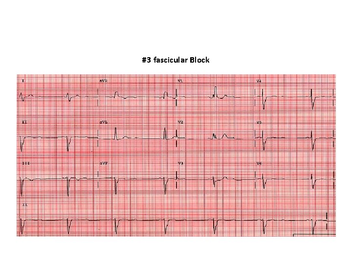 #3 fascicular Block 