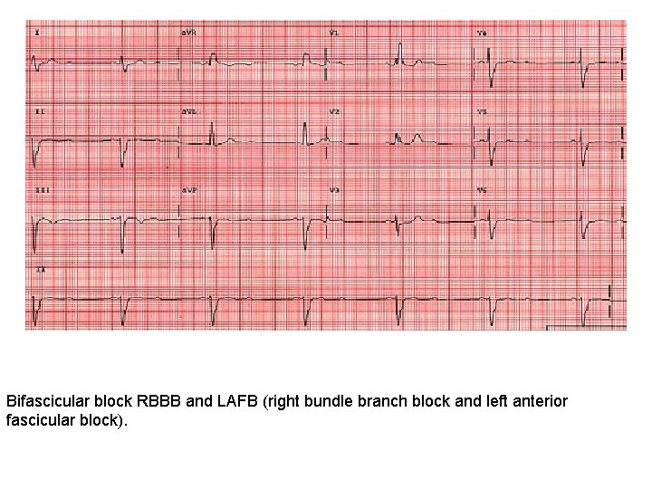 Bifascicular block RBBB and LAFB (right bundle branch block and left anterior fascicular block).