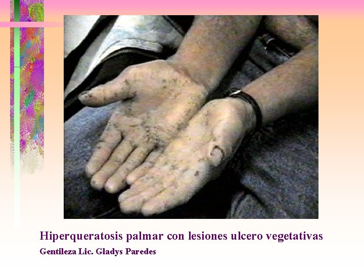 Hiperqueratosis palmar con lesiones ulcero vegetativas Gentileza Lic. Gladys Paredes 