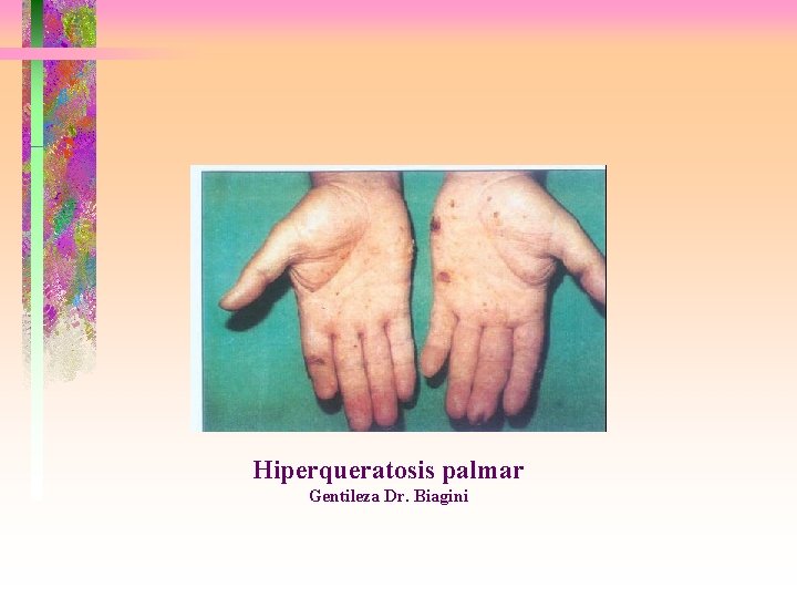 Hiperqueratosis palmar Gentileza Dr. Biagini 