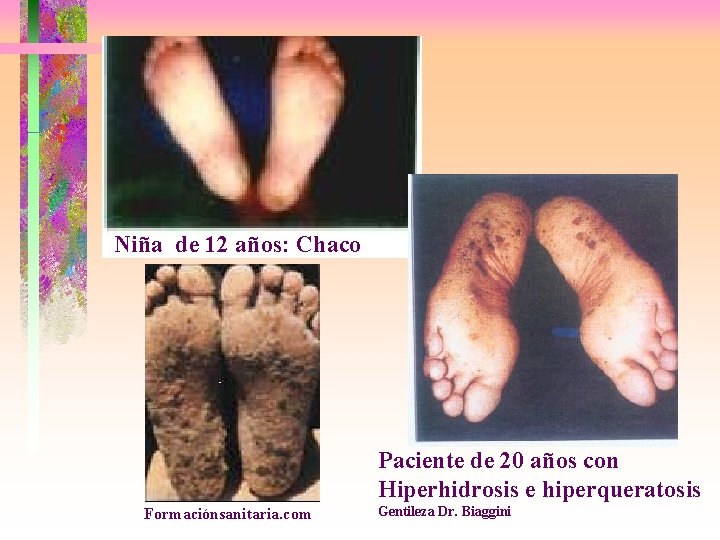 Niña de 12 años: Chaco Paciente de 20 años con Hiperhidrosis e hiperqueratosis Formaciónsanitaria.