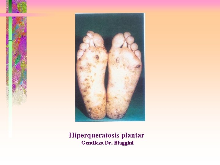 Hiperqueratosis plantar Gentileza Dr. Biaggini 