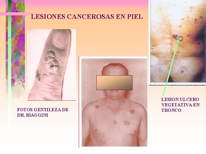 LESIONES CANCEROSAS EN PIEL FOTOS GENTILEZA DE DR. BIAGGINI LESION ULCERO VEGETATIVA EN TRONCO