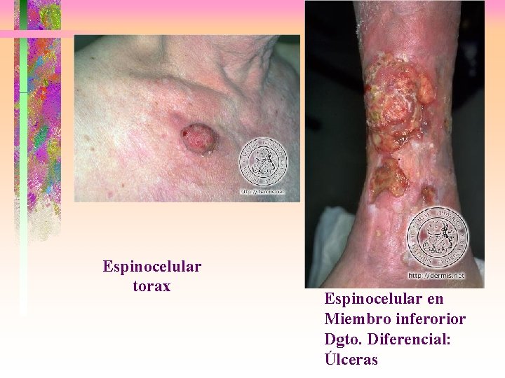 Espinocelular torax Espinocelular en Miembro inferorior Dgto. Diferencial: Úlceras 