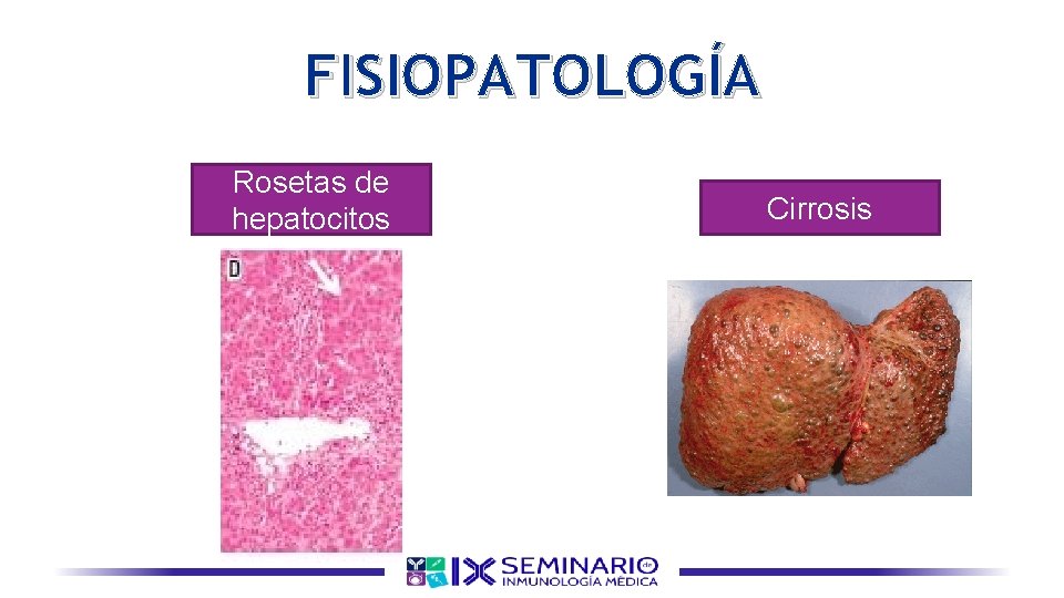 FISIOPATOLOGÍA Rosetas de hepatocitos Cirrosis 