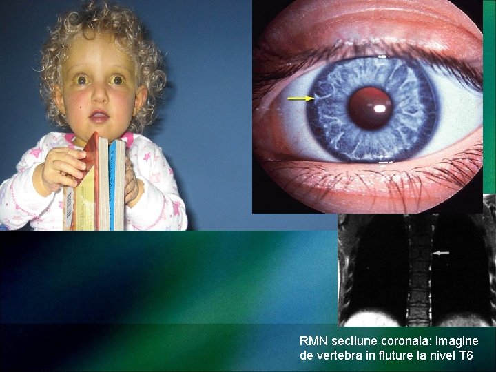 RMN sectiune coronala: imagine de vertebra in fluture la nivel T 6 