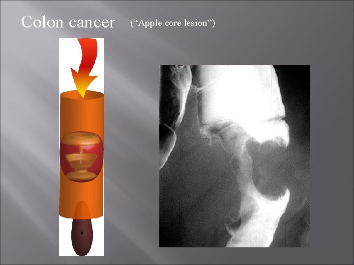 Colon cancer (“Apple core lesion”) 