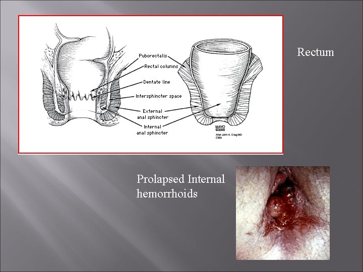 Rectum Prolapsed Internal hemorrhoids 