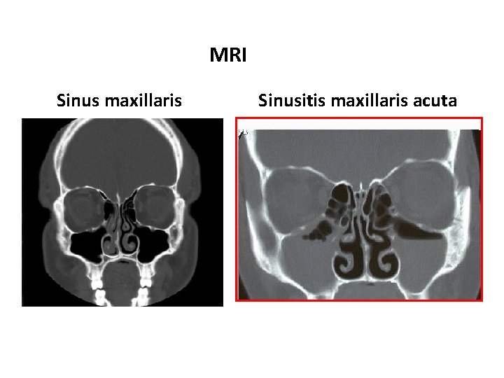MRI Sinus maxillaris Sinusitis maxillaris acuta 