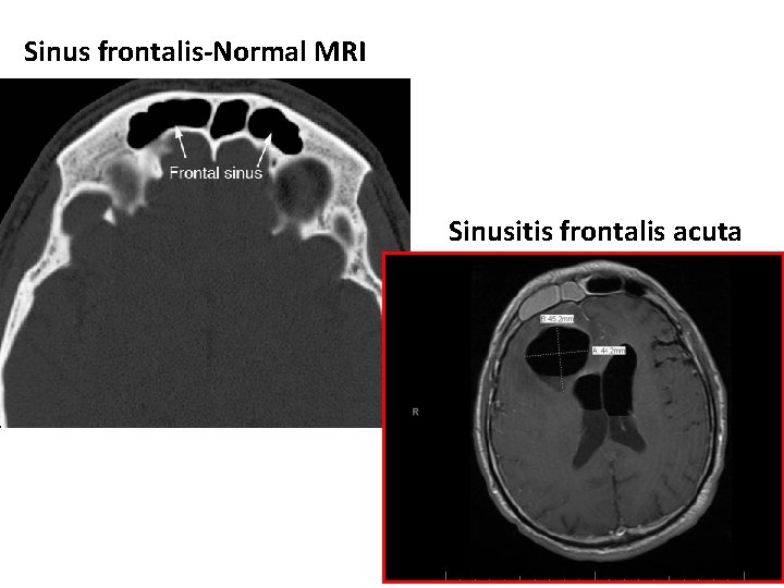 Sinus frontalis-Normal MRI Sinusitis frontalis acuta 